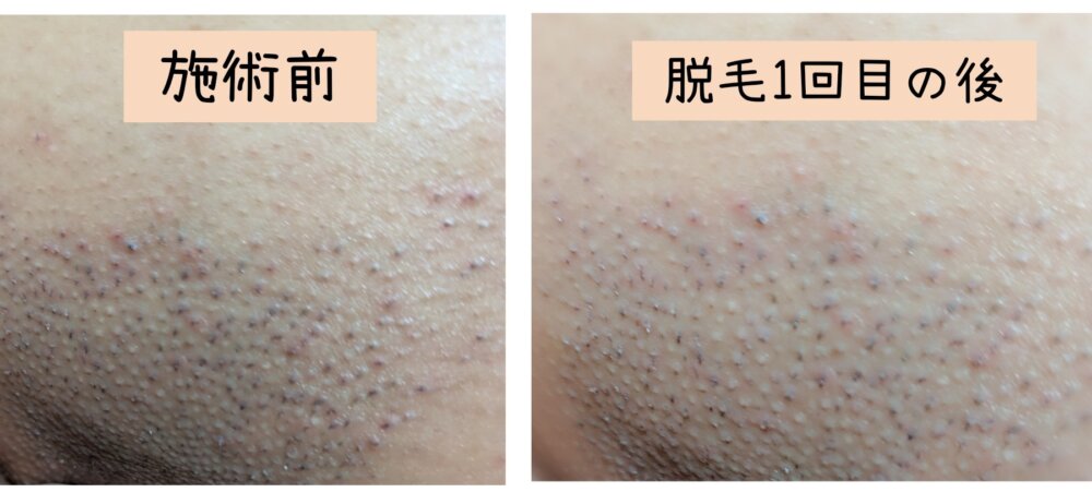 脱毛効果1回目