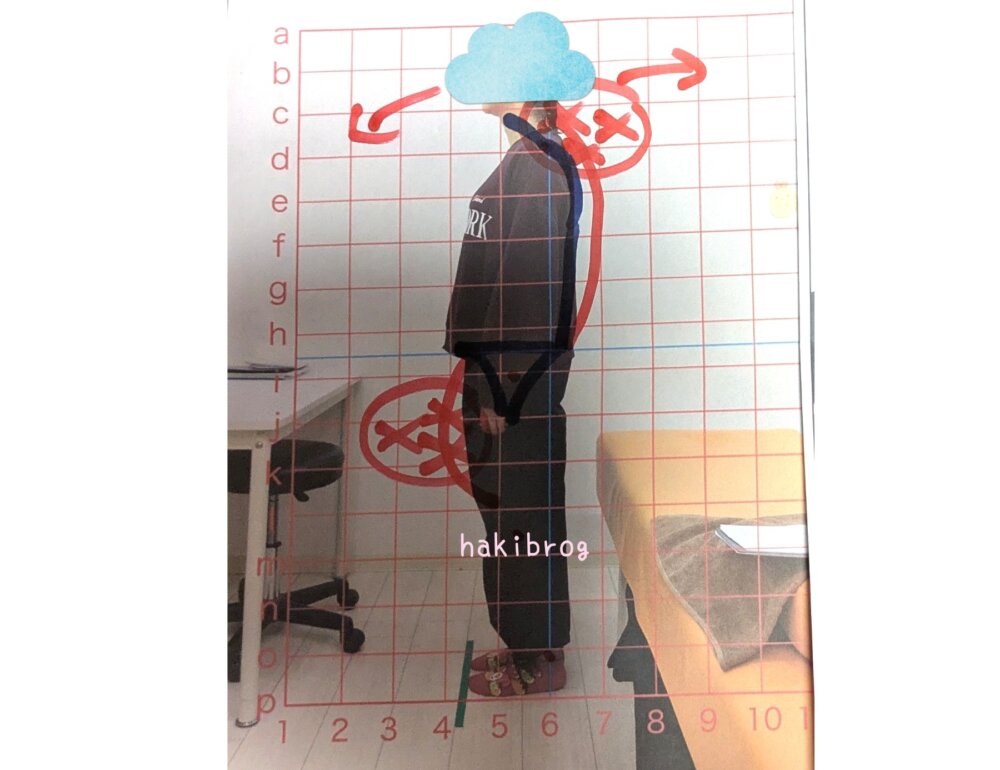 ストレートネック　見た目　横