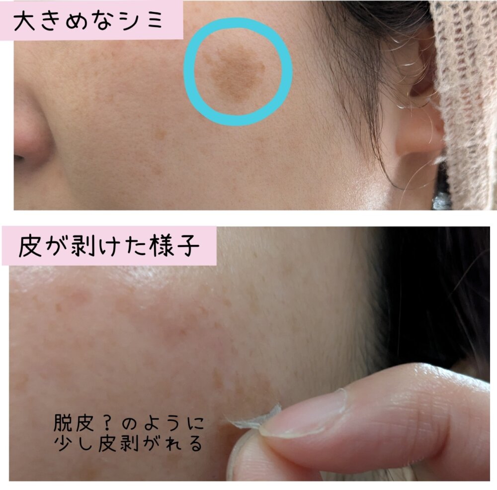 KISOハイドロキノン10%使用中の肌の様子(皮むけの状態)